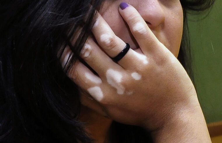 📅 Dia Mundial do Vitiligo busca combater o preconceito contra a condição